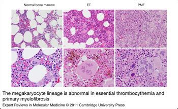 megashare malignant|Normal and Malignant Megakaryopoiesis .